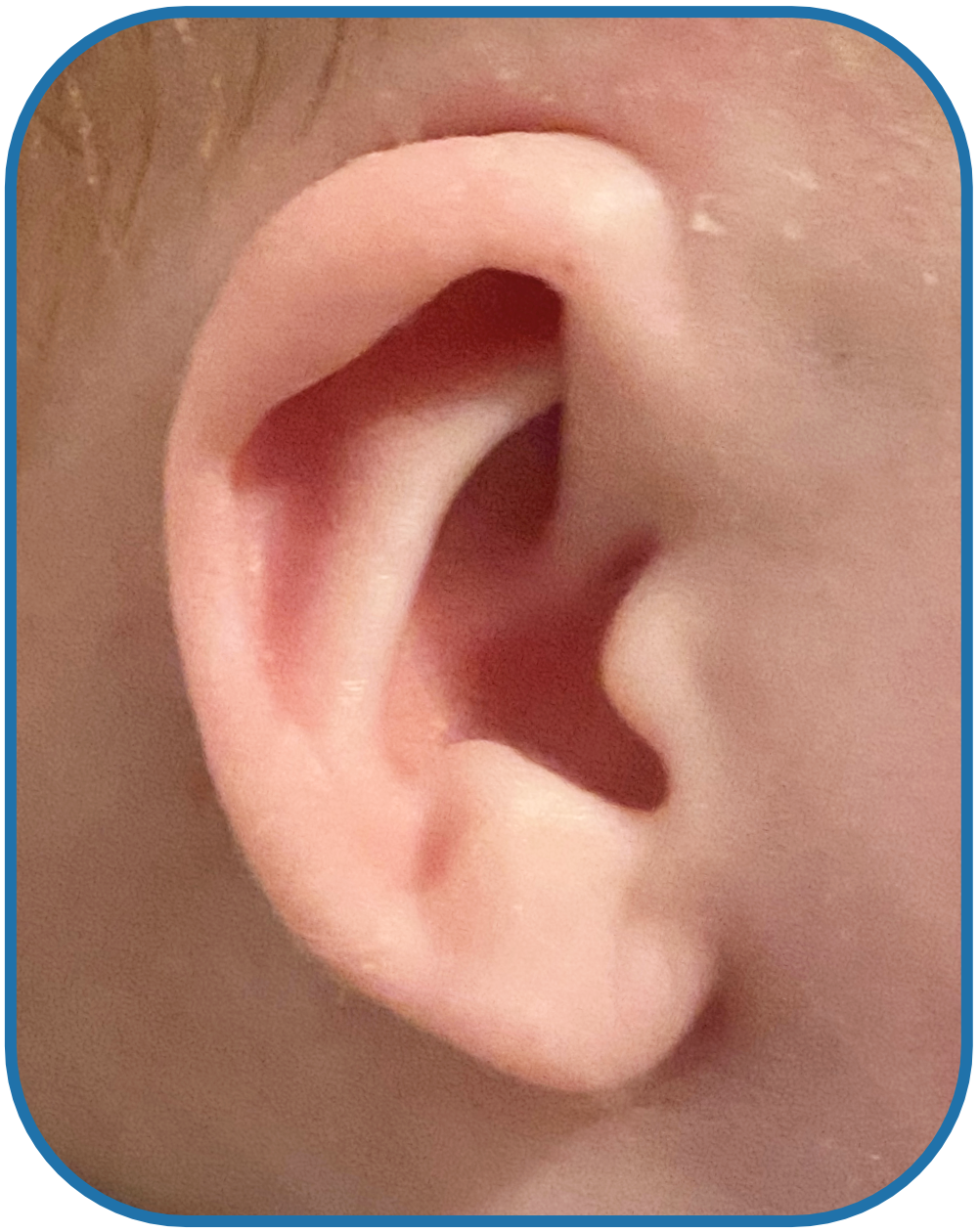 Cryptotia ear solution baby