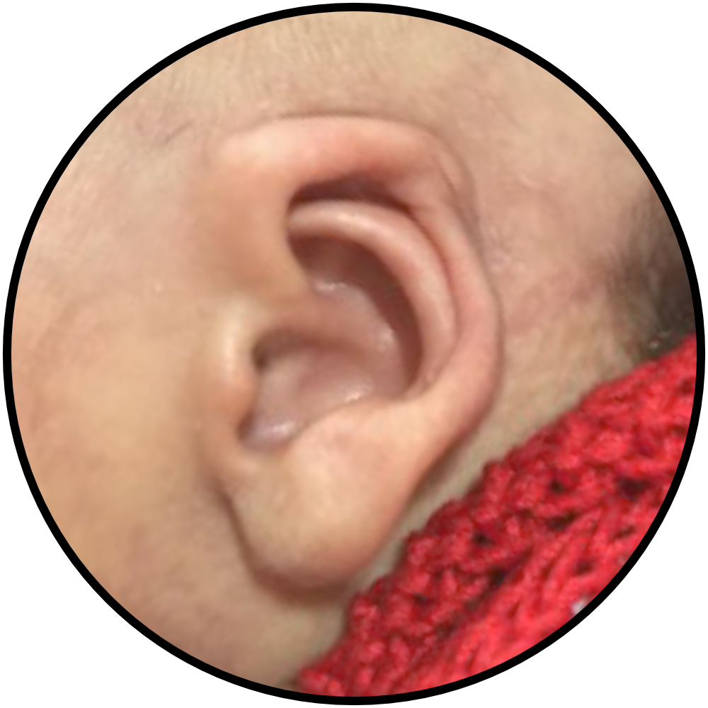 baby with cryptotia ear