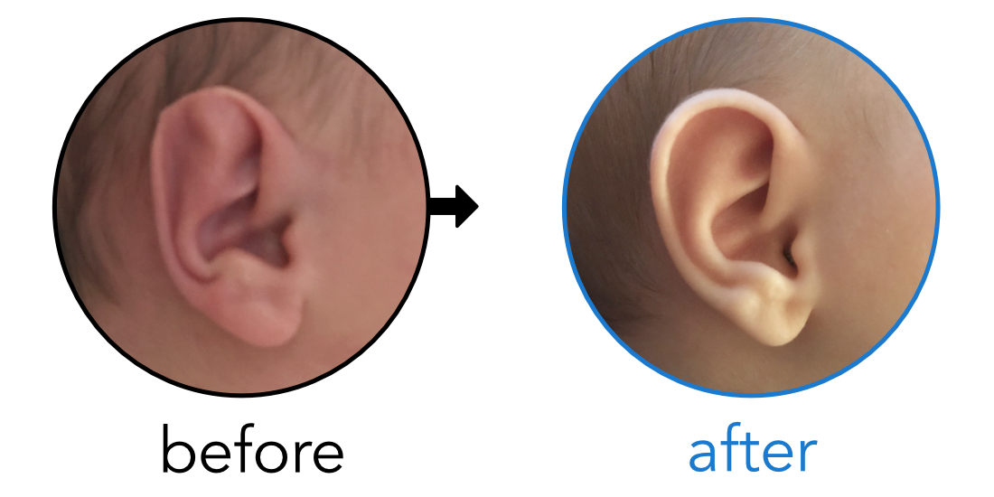 baby's ear folded over - stahl's ear