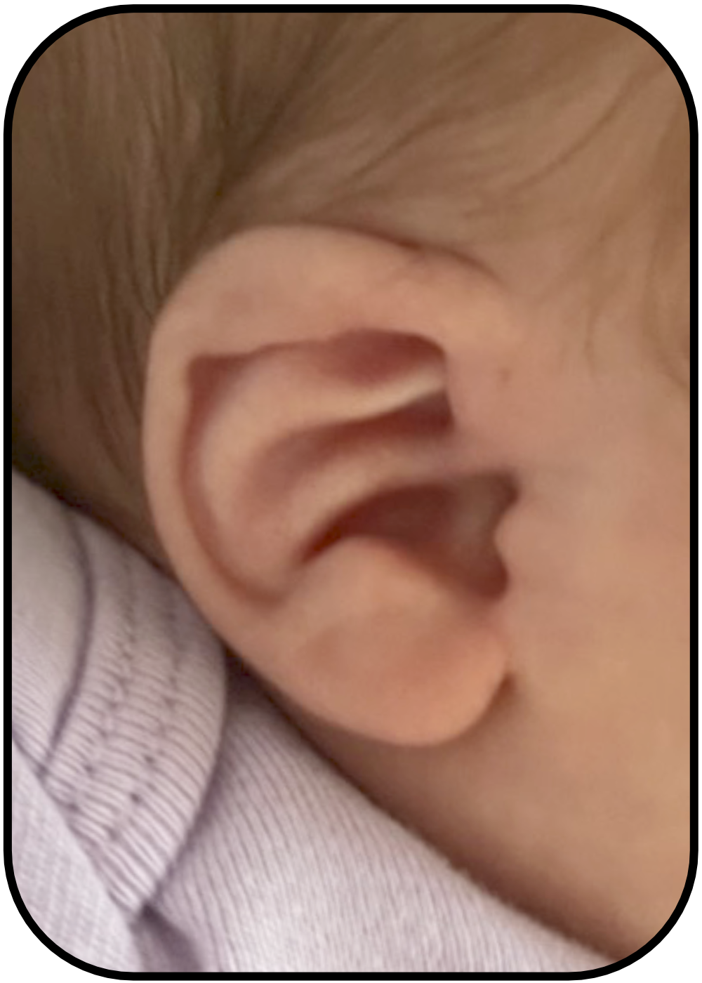 baby ear sticking out