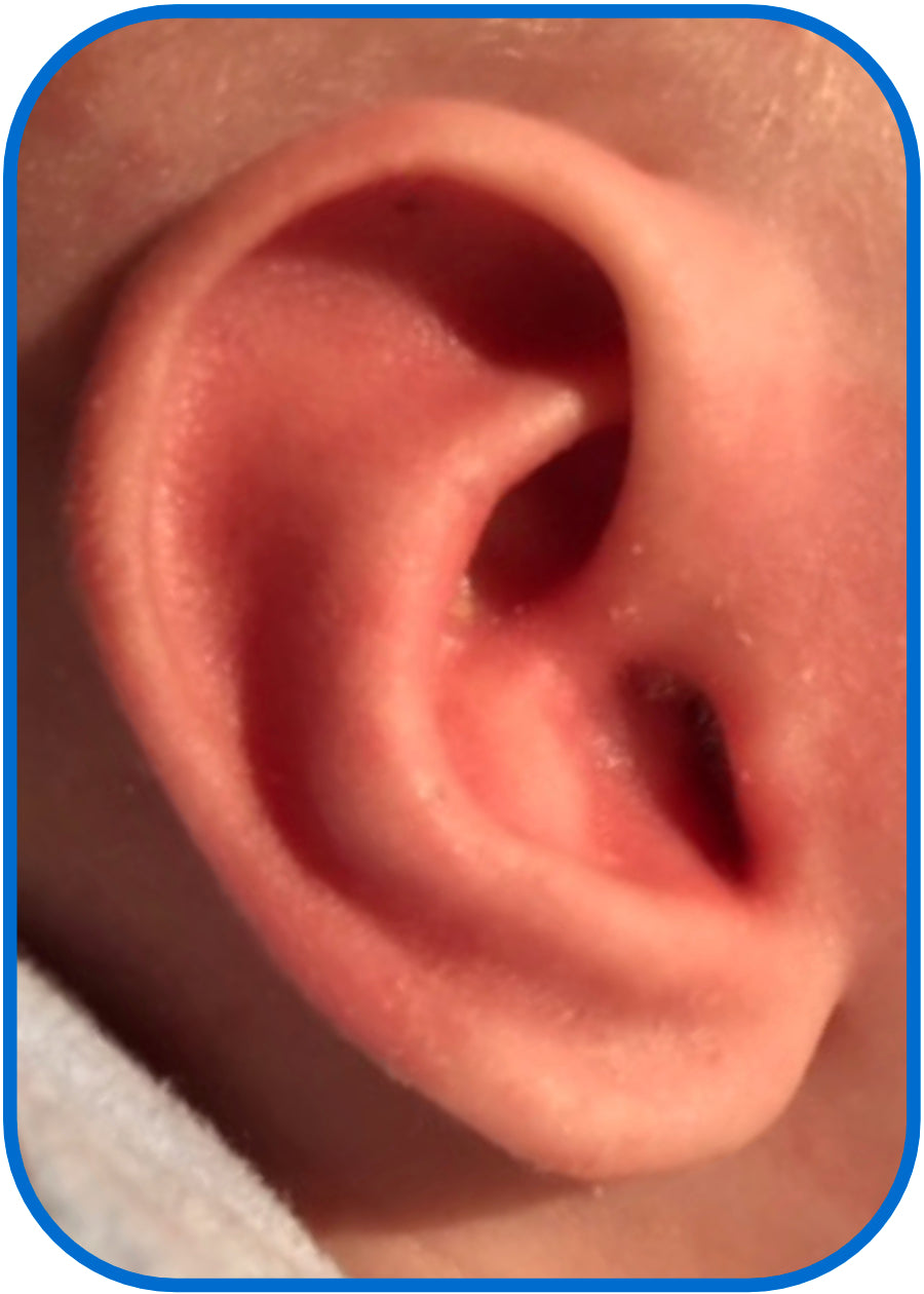 corrected conchal bowl baby ear