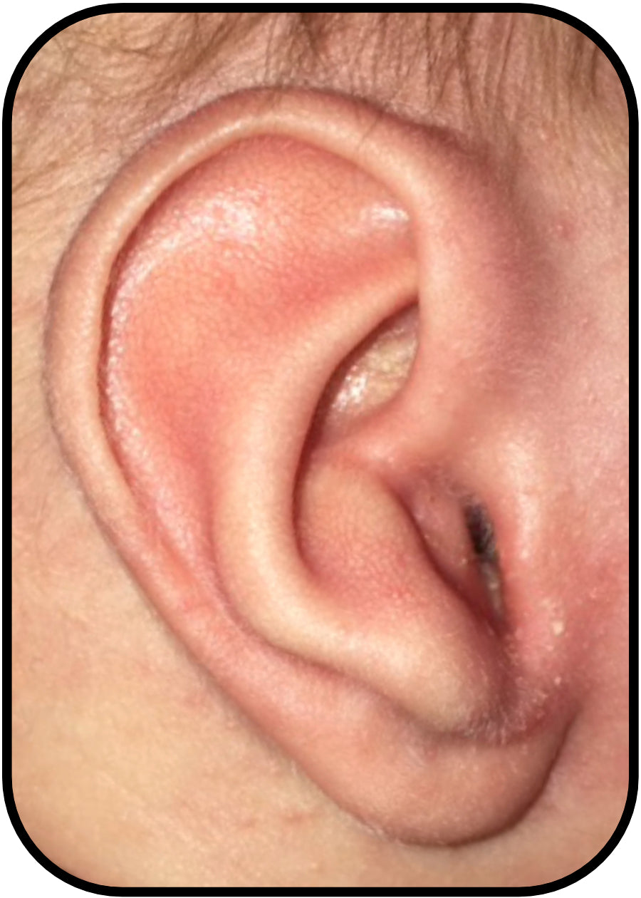 baby ear with inverted conchal bowl