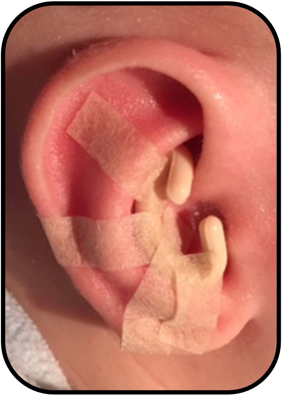 ear buddies parent conceal crus fitting