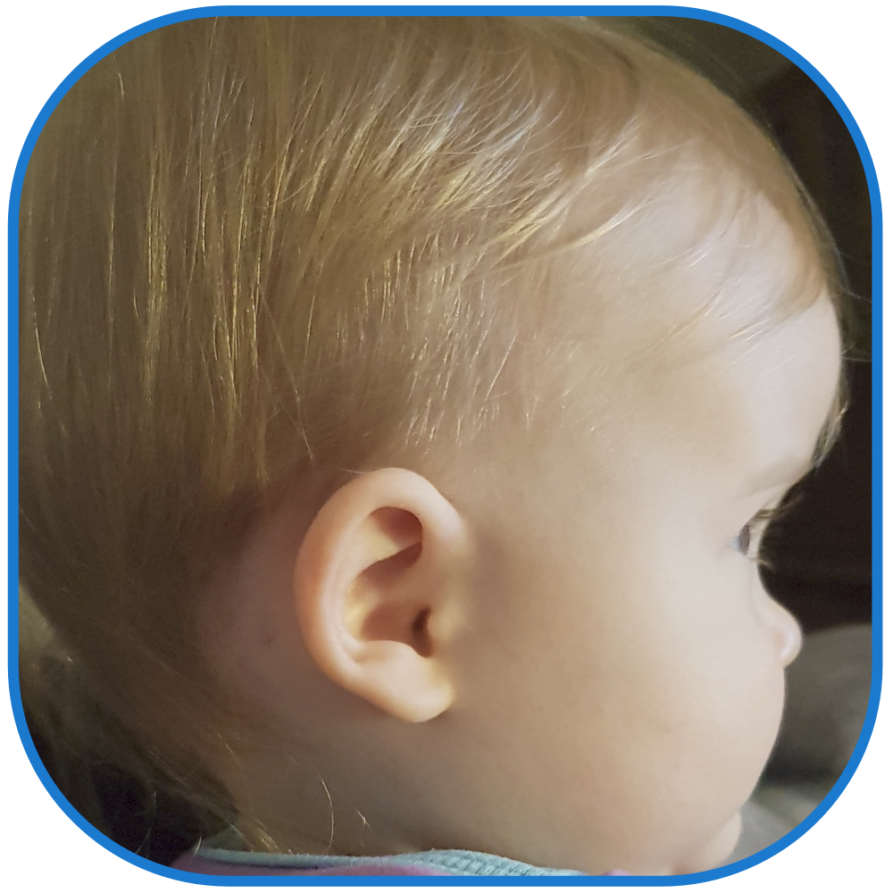 Baby with ear buddies used