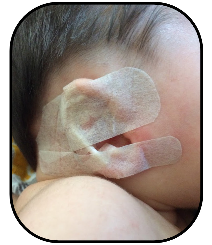 baby ear lobe deformity fix