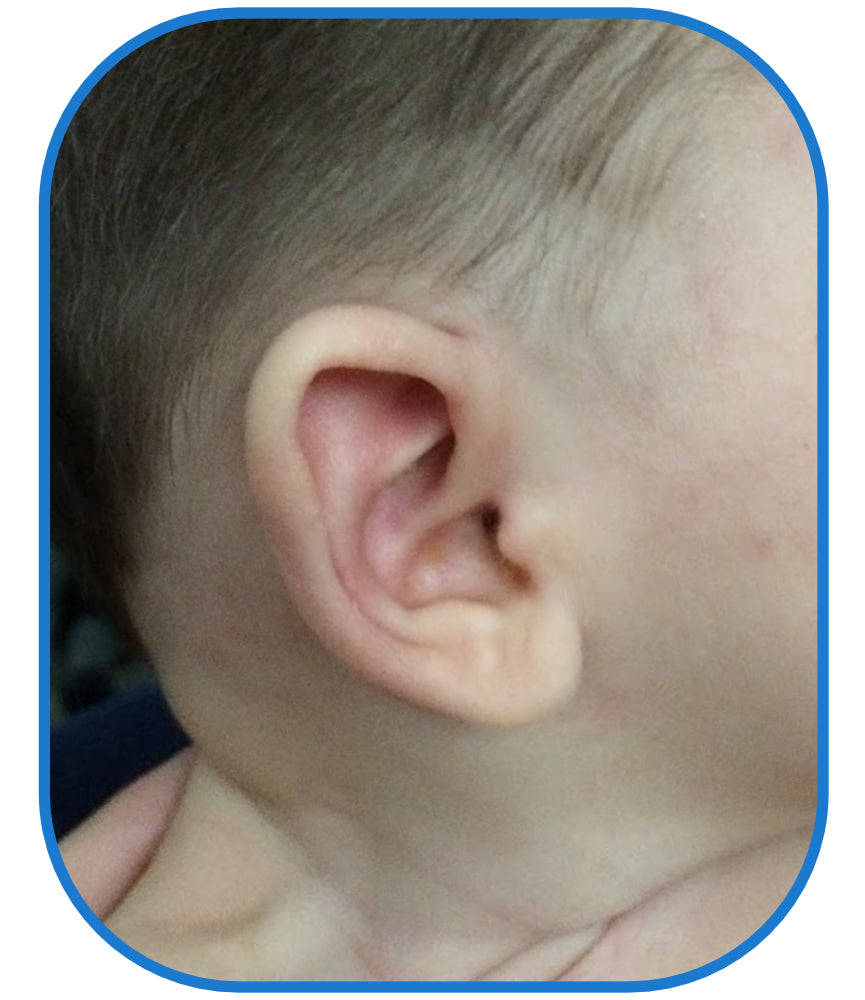 baby's ear lobe fix