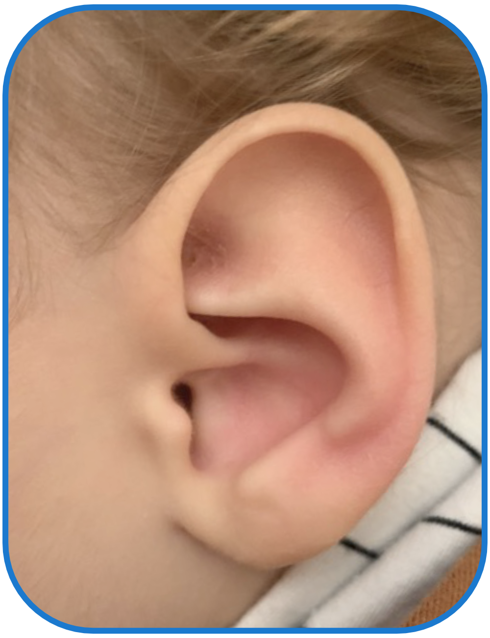 Baby photo after ear buddies used - longterm results