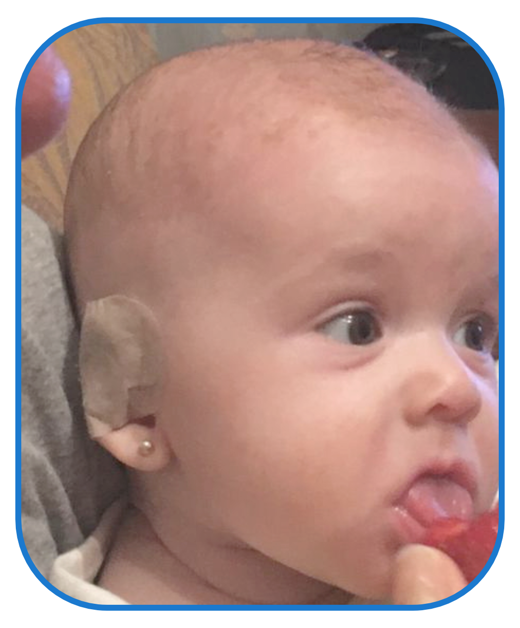 baby's ear splint treatment with ear buddies
