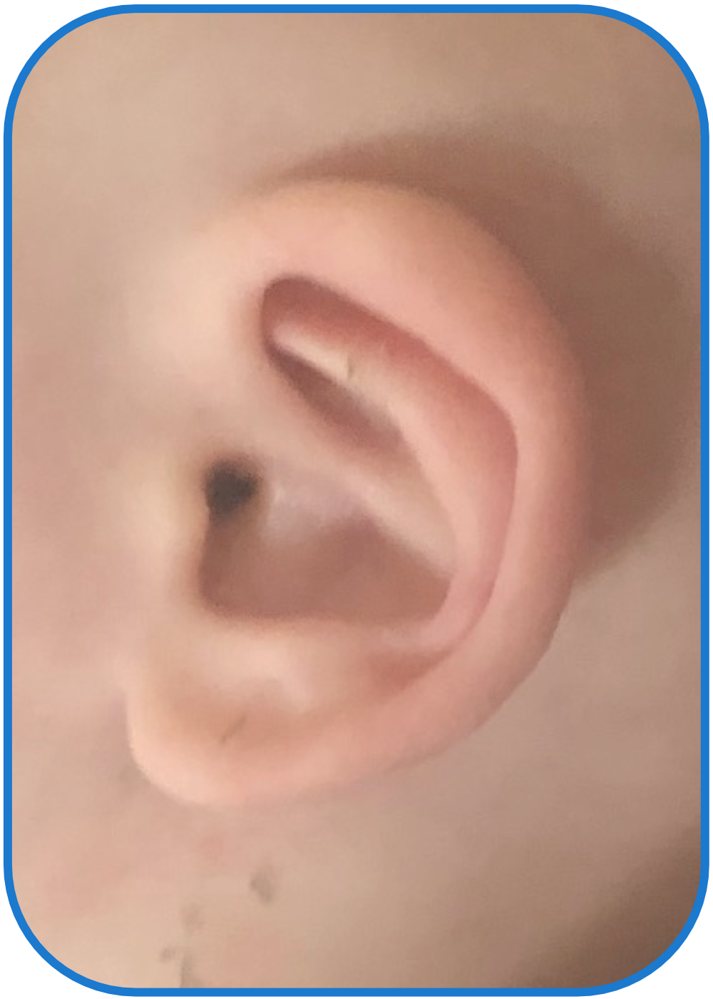 Baby Ear fixed with Ear Buddies