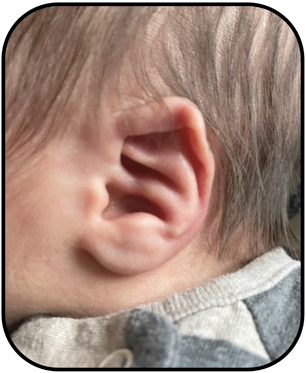 baby ear sticks out
