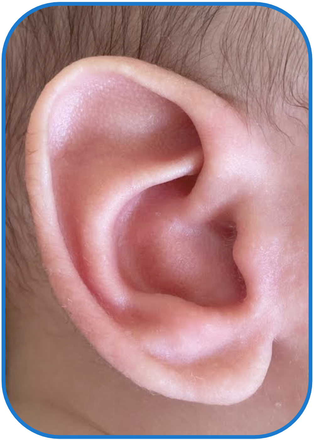 Baby photo after ear buddies used - longterm results