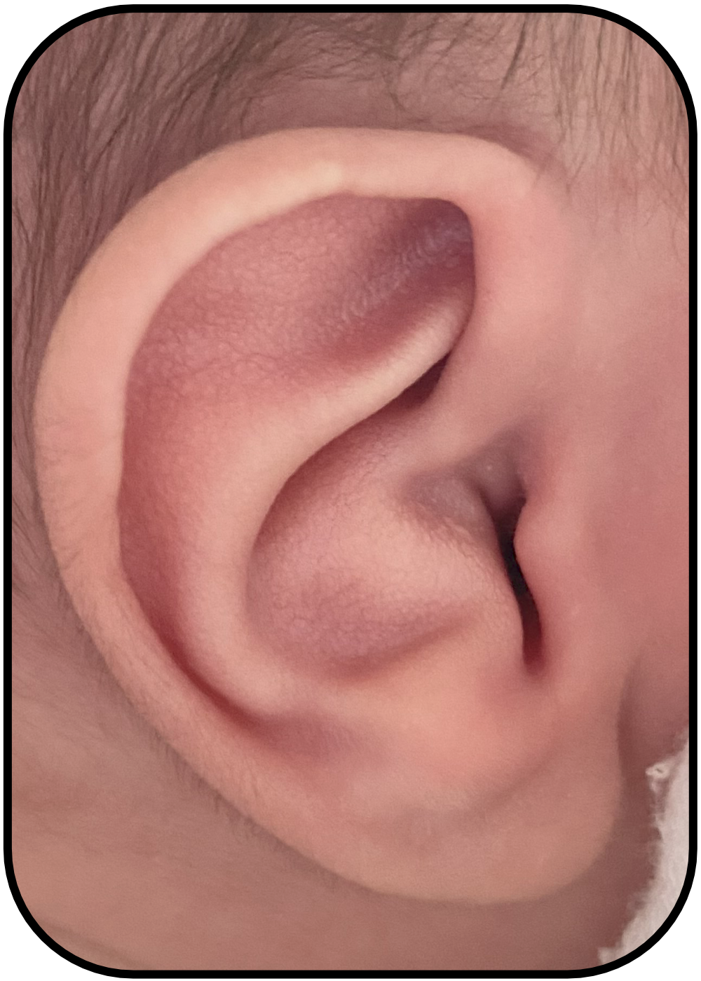 baby with Conchal crus ear