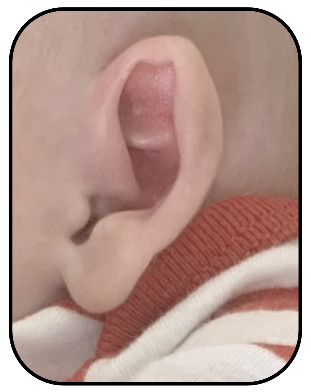 baby ear sticks out