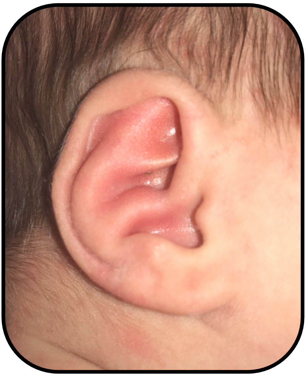 Baby with Conchal Crus Ear Deformity