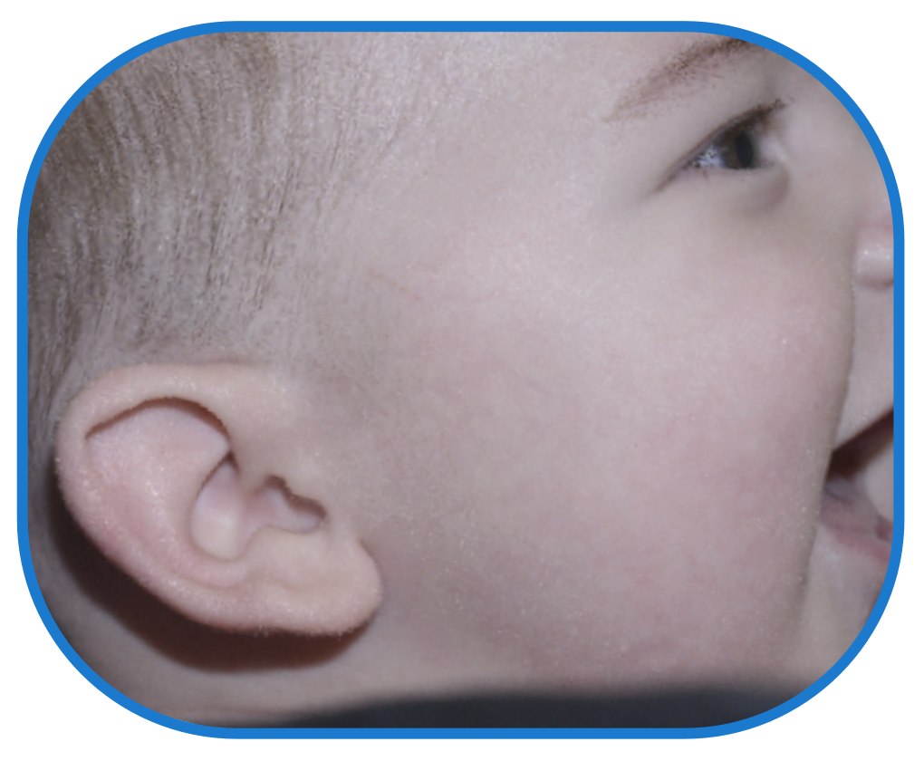 Baby photo after ear buddies - results