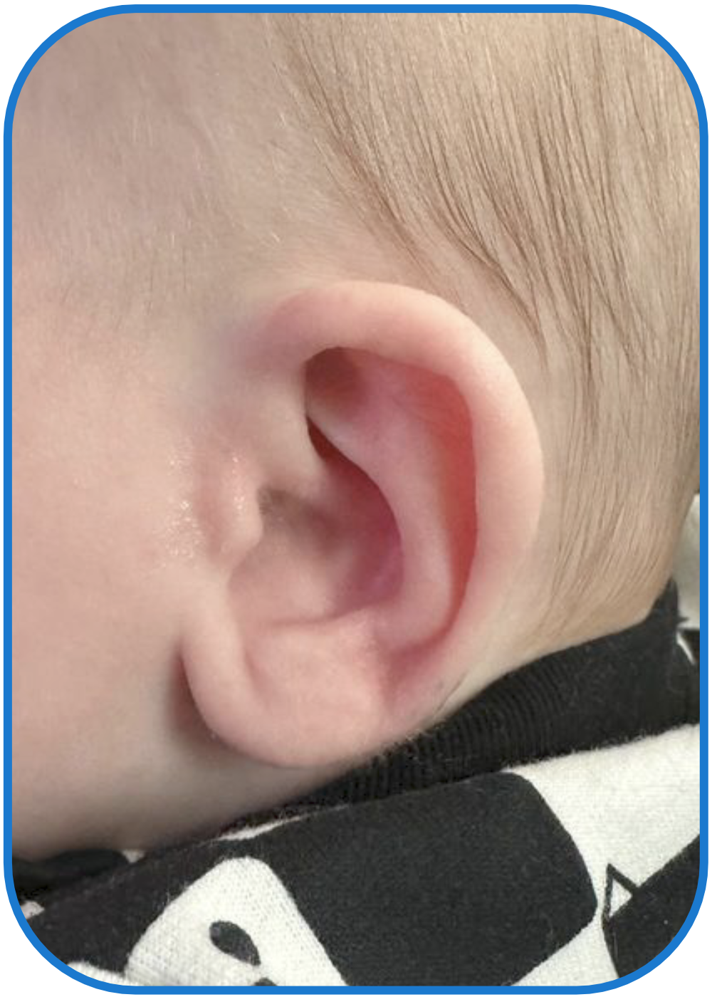 prominent ears solution baby