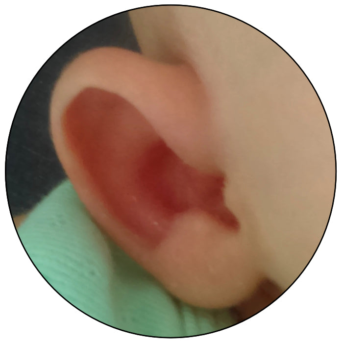 fix prominent baby ear what to do
