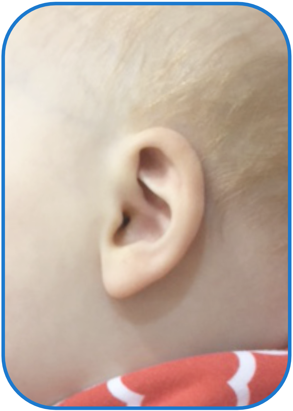 baby cryptotia ear fixed