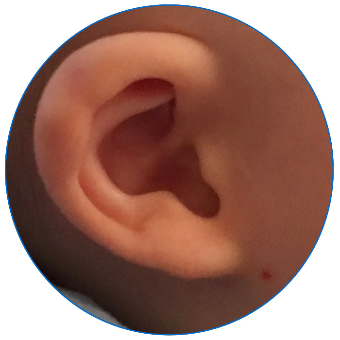 correction of sticky out baby ears corrected with earbuddies parent review uk
