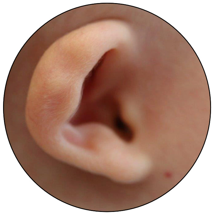 fix cauliflower baby ear cupped folded what to do