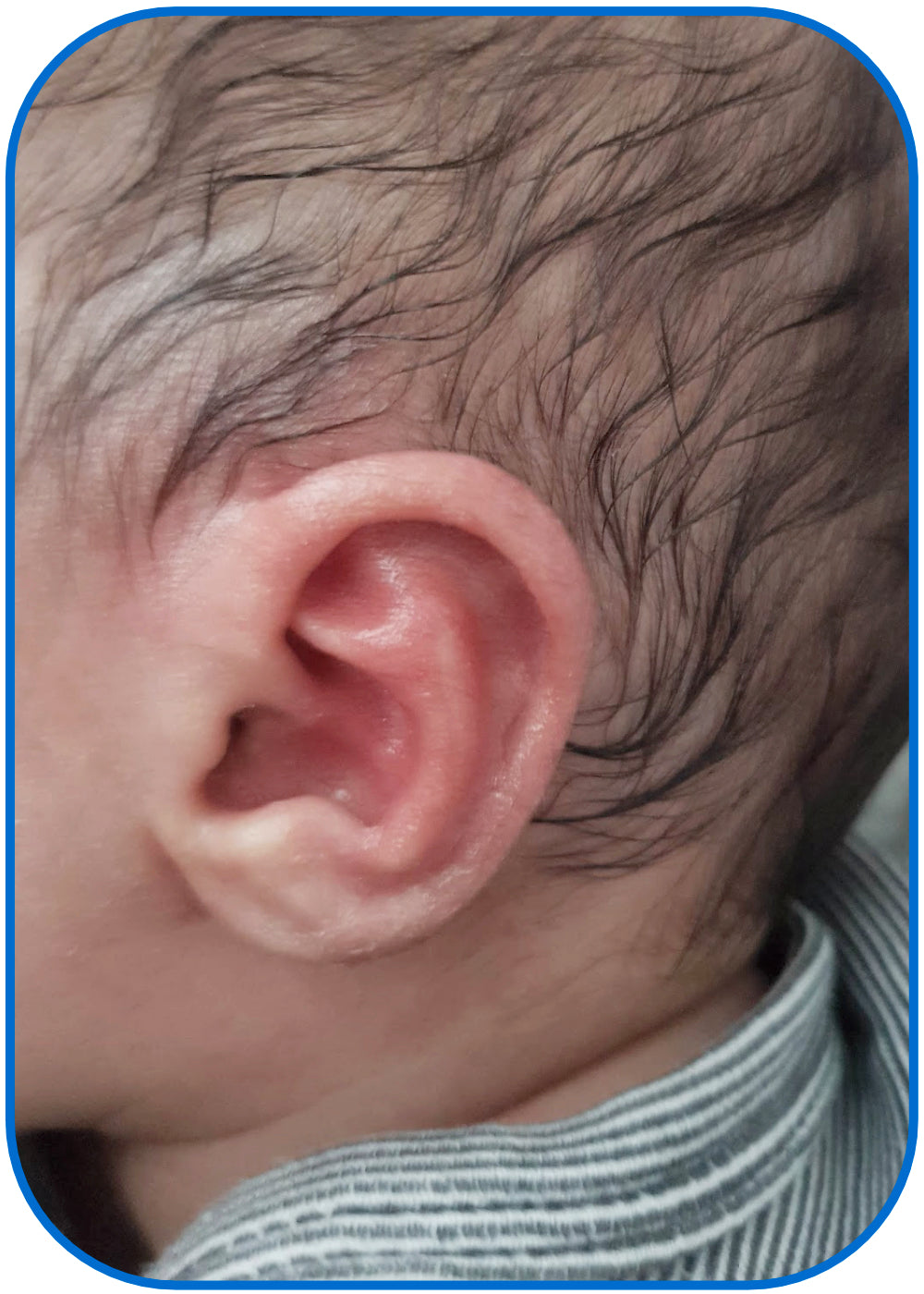 babies ear after ear buddies