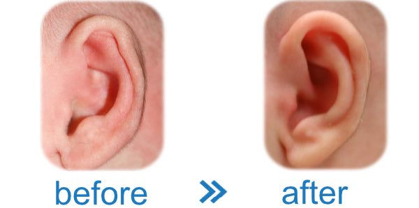 Picture of a Baby's Ear with a Folded Over Rim fixed with an ear corrector device