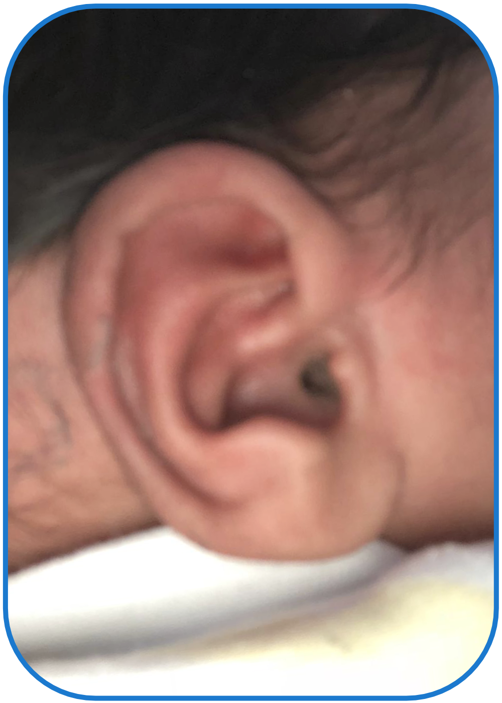 Folded Over Ear Fixed without Surgery