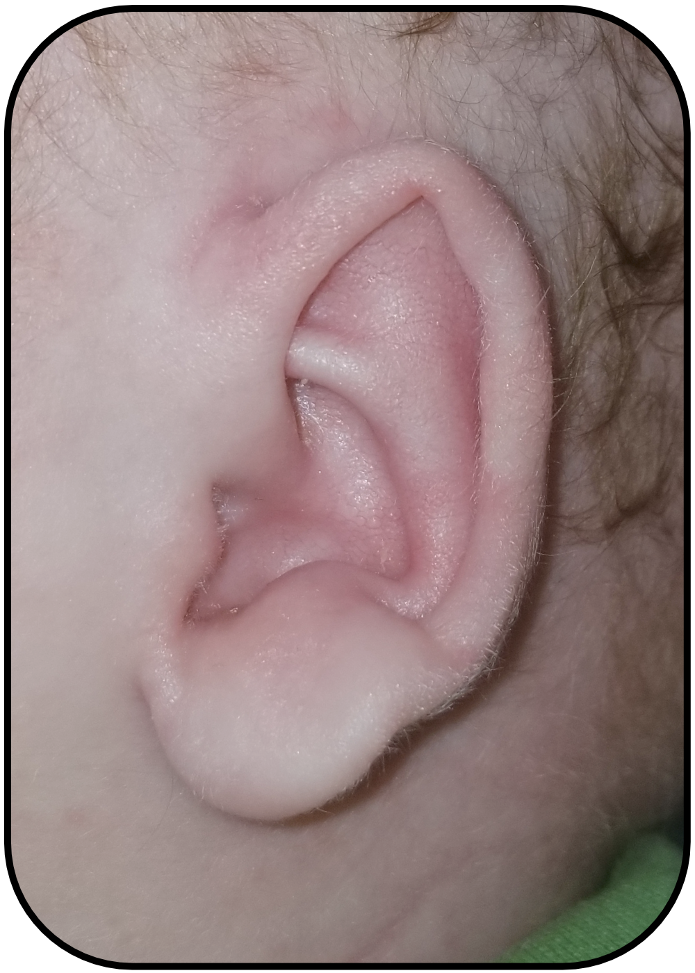 Folded Over Ears can be Fixed without Surgery