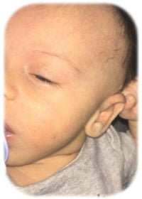 ear pointed at the top | baby ear folds forward | before and after results