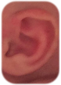 after 2 weeks using earbuddies to treat a stahl's bar or spock ear