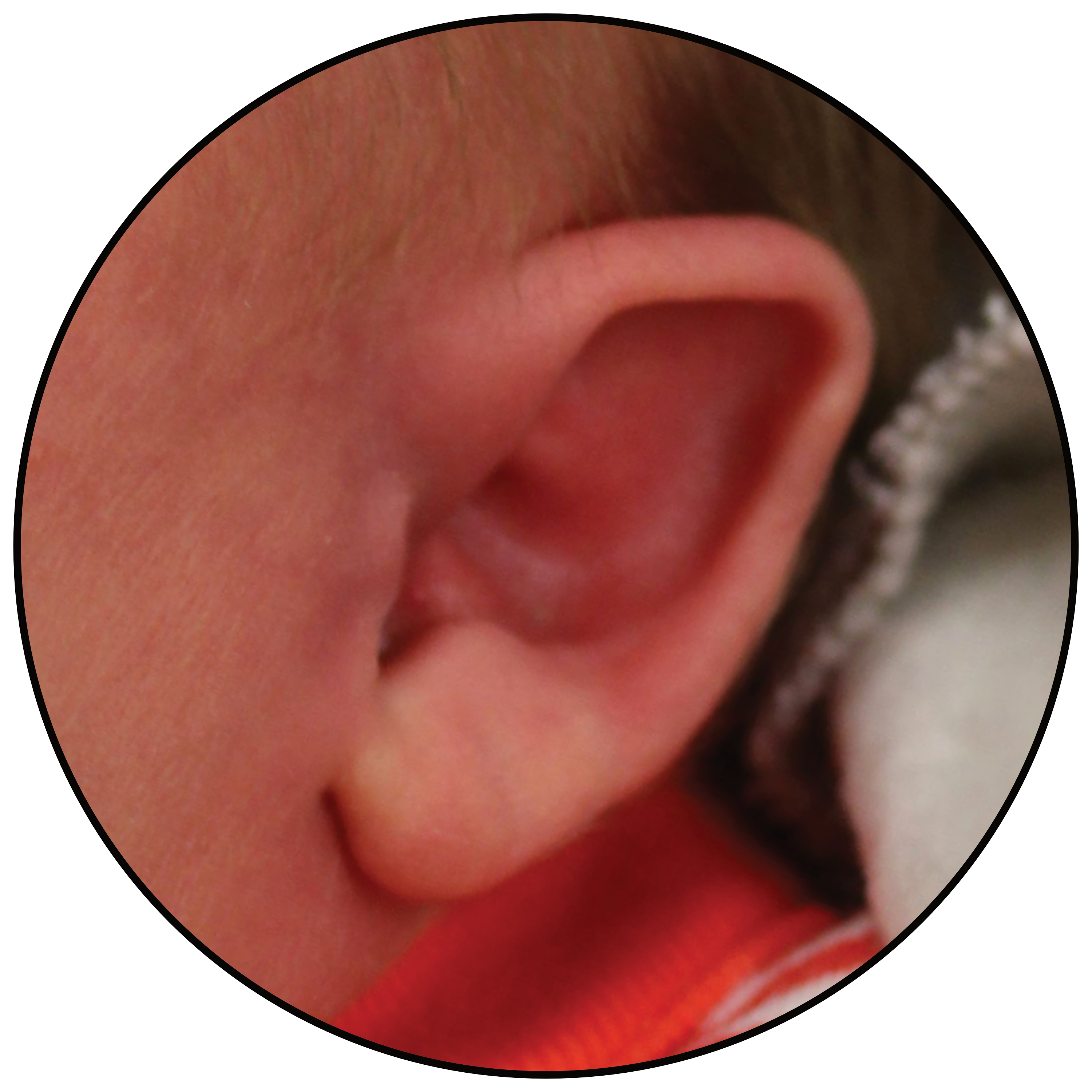 baby born with folded down ear