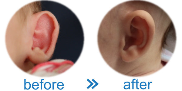 baby ear rim folds forward. Should I worry? | See these results!