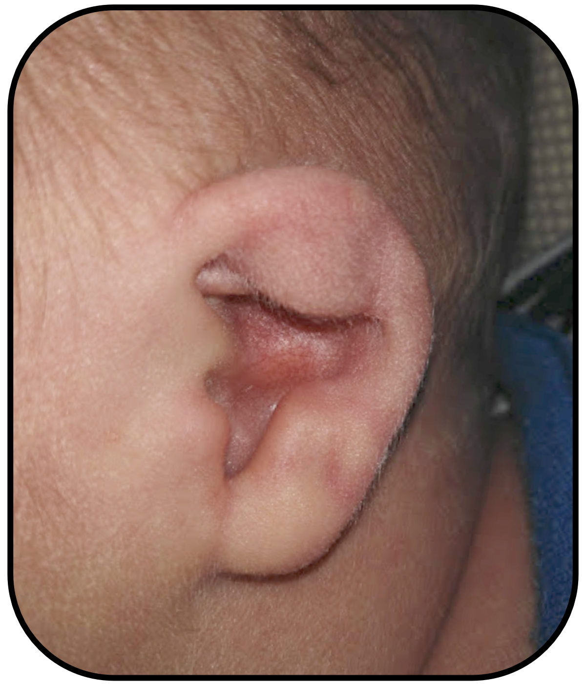 Baby's Ear folds over