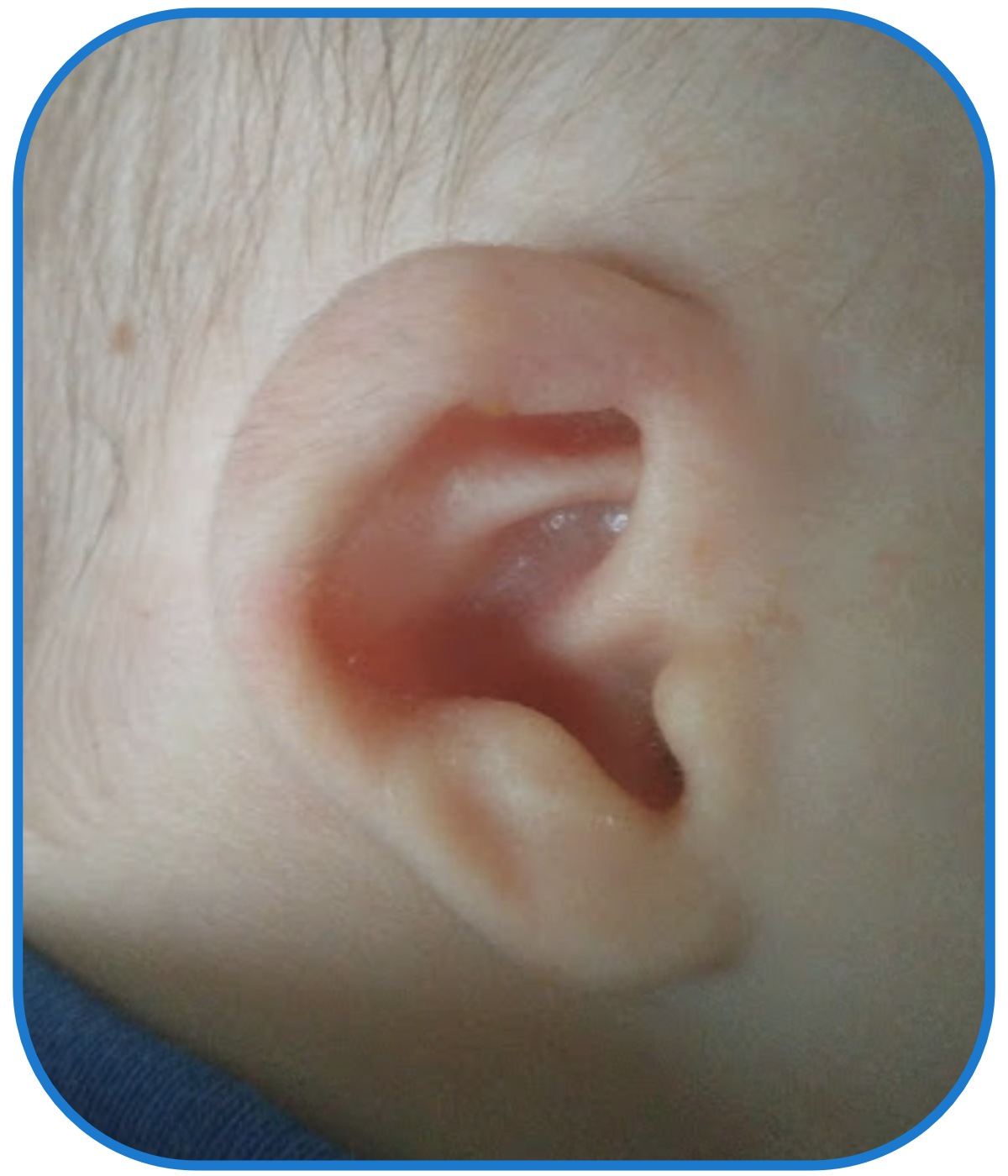 Ear Buddies Results