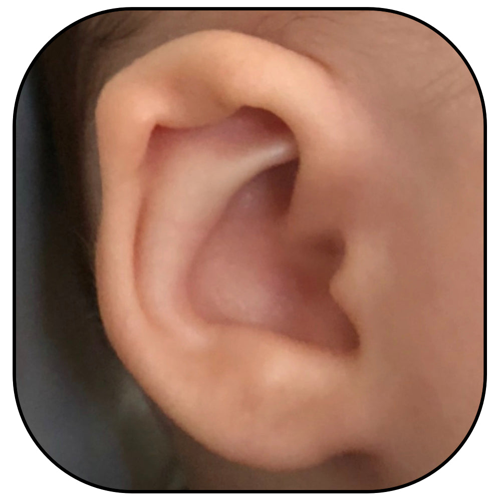 baby ear with inverted conchal bowl