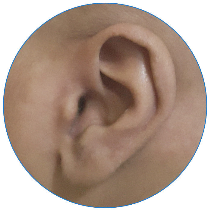 correction of sticking out ears with ear buddies | parent review