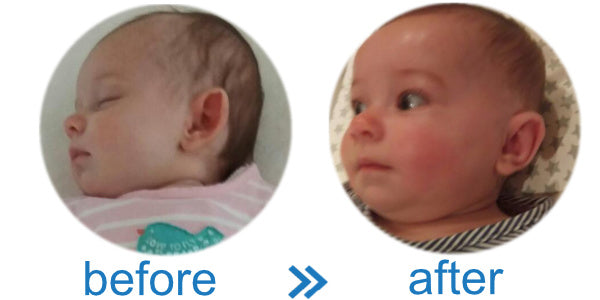Baby got stick out ears | avoid surgery with ear reshapers | EarBuddies™