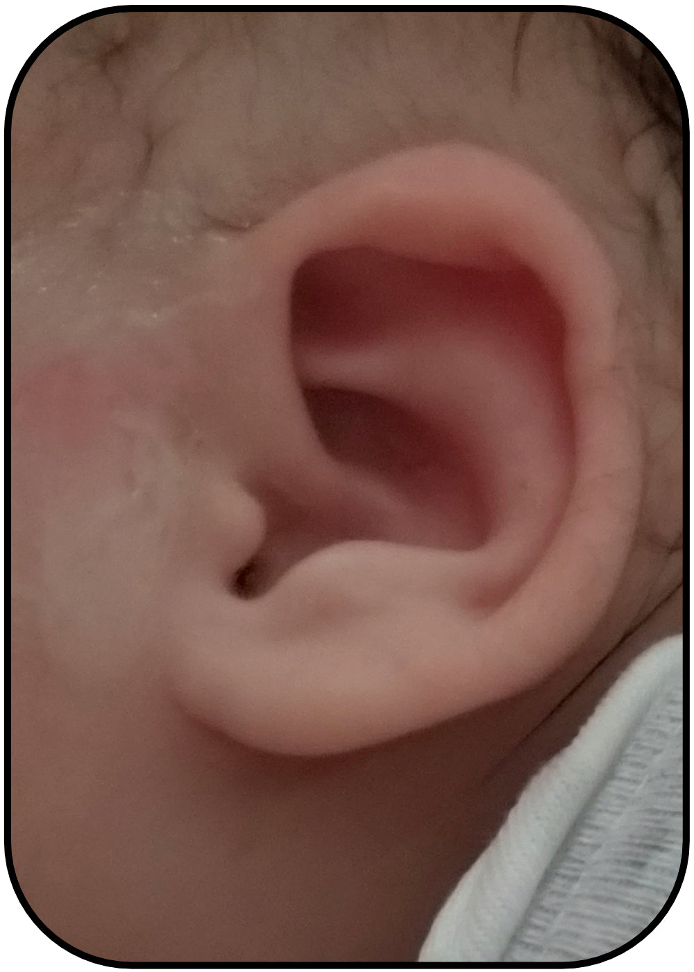 folded Ear Fixed without Surgery