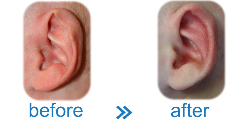 Will my baby’s ears always stick out and fold over? Use EarBuddies and avoid this, as shown in the picture