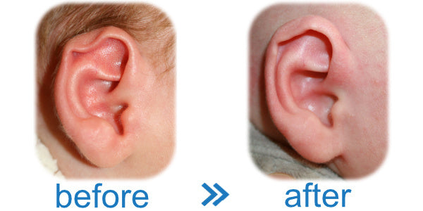 Splint ears to correct Rim Kink Deformity in Baby and Infant Ear
