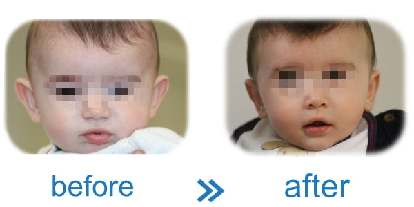 babies ears starting to stick out? See before and after pictures of EarBuddies™ working!