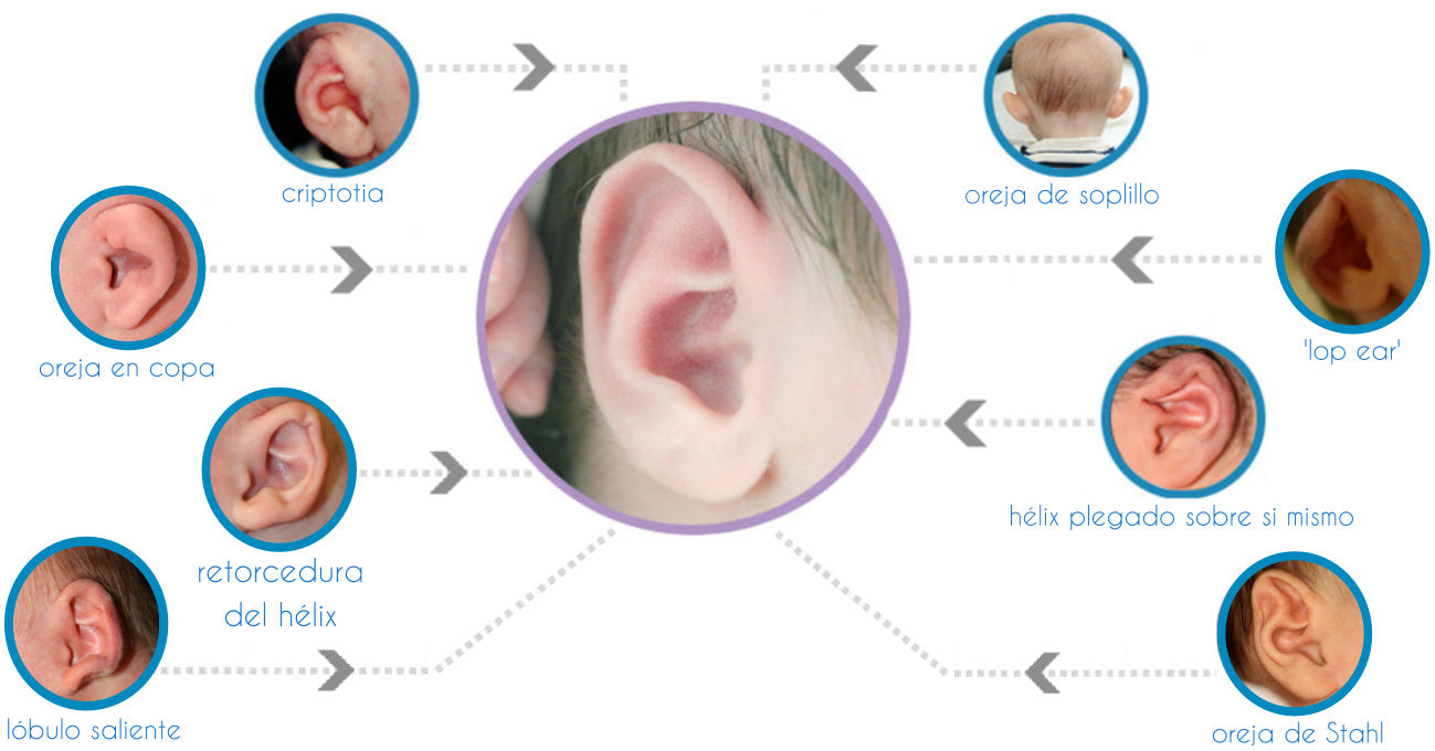 Se pueden tratar orejas despegadas sin cirugía?