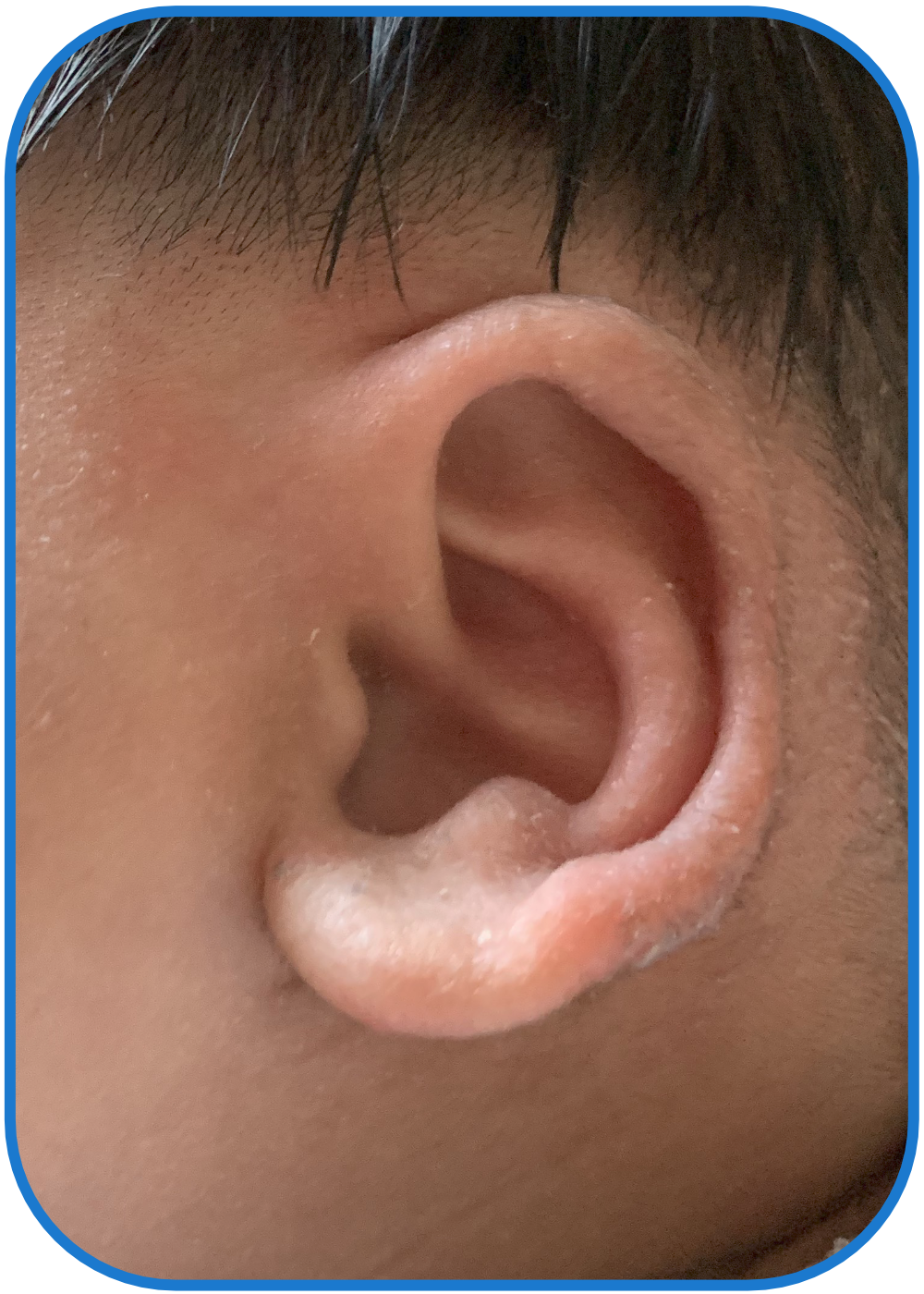 ear buddies parent stick out lobes result