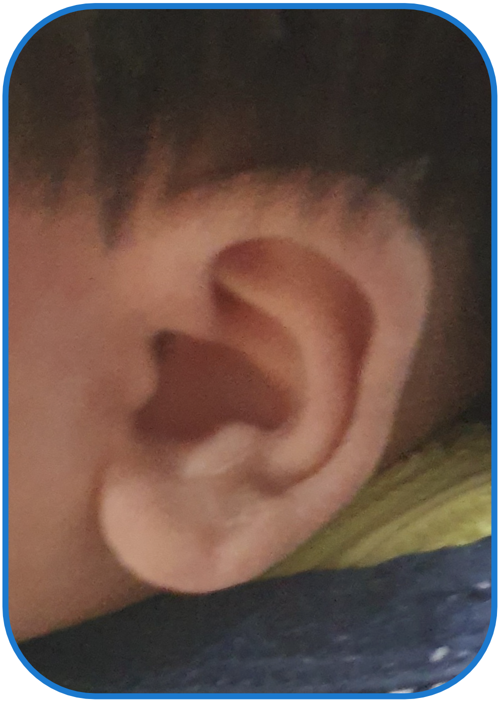 corrected stick out lobe in baby ear