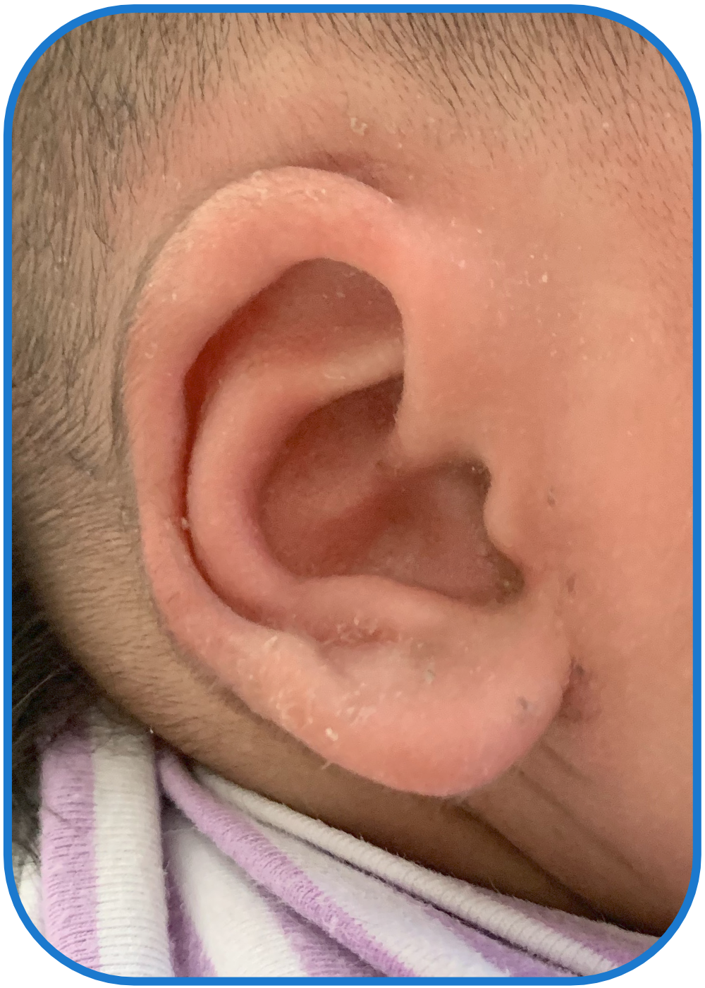 ear buddies parent stick out lobes result