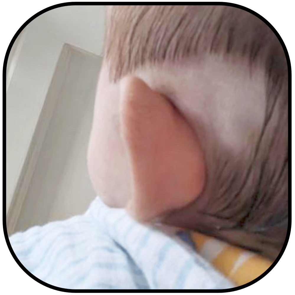 Infant Ear Corrector Baby Ear Tape with Locator Ear Aesthetic