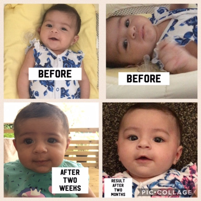 correction of sticking out ears with ear buddies | parent review
