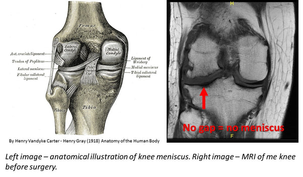 How I biohacked my knee surgery