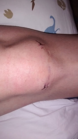 How I biohacked my knee surgery