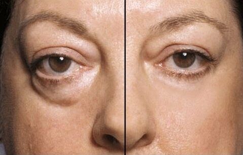 bag under the eyes before after